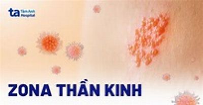 Zona thần kinh c&oacute; l&acirc;y kh&ocirc;ng, c&aacute;ch n&agrave;o ph&ograve;ng tr&aacute;nh?