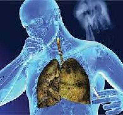 6 loại ung thư thường gặp, người tr&ecirc;n 50 tuổi c&oacute; nguy cơ cao