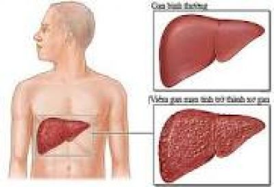 Bệnh gan nhiễm mỡ: 3 dấu hiệu cho thấy mức độ nghiêm trọng