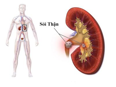 Bác sĩ chia sẻ những thực phẩm người bị sỏi thận nên và kiêng ăn