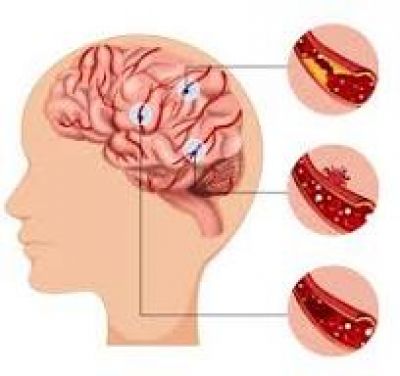 Những điều có thể bạn chưa biết về đột quỵ