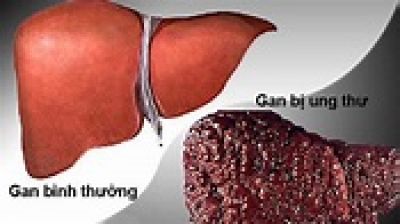 6 loại ung thư triệu chứng mờ nhạt, dễ bị ng&oacute; lơ