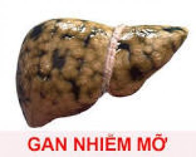 Gan nhiễm mỡ: Chảy máu cam thường xuyên là dấu hiệu giai đoạn nặng