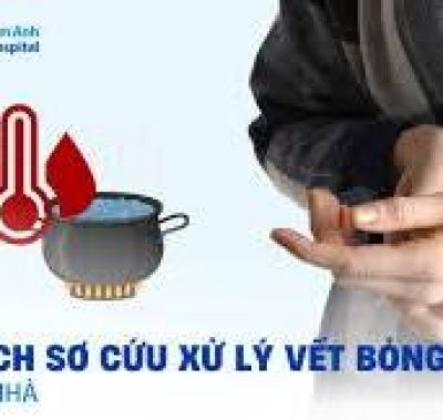 Bị bỏng c&oacute; n&ecirc;n chườm đ&aacute;, b&ocirc;i kem đ&aacute;nh răng?