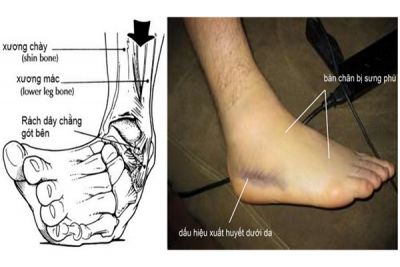 Làm gì ngay khi bị bong gân cổ chân?